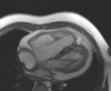 File:Arrhythmogenic right ventricular cardiomyopathy (Radiopaedia 69431-79307 4ch cine 78).jpg