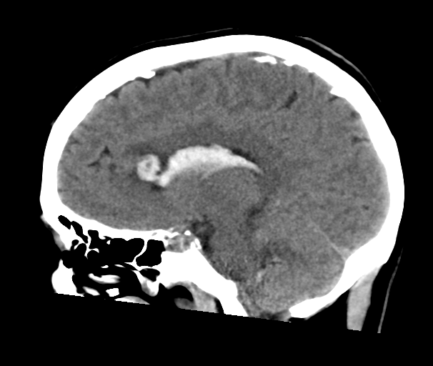 File:Arteriovenous malformation (cerebral) (Radiopaedia 40070-42579 B 15).png