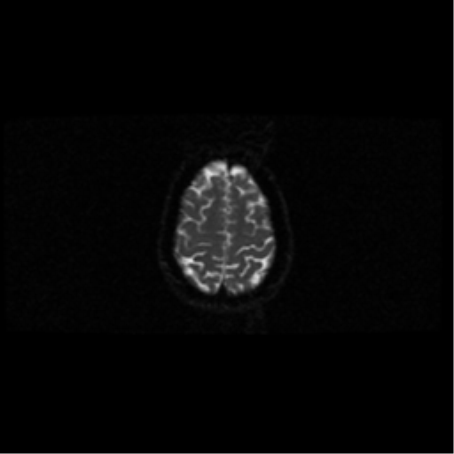 File:Arteriovenous malformation (cerebral) (Radiopaedia 40070-42580 Axial DWI 41).png