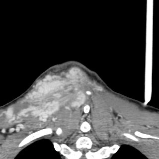 Arteriovenous malformation of the neck (Radiopaedia 53935-60062 D 59).jpg