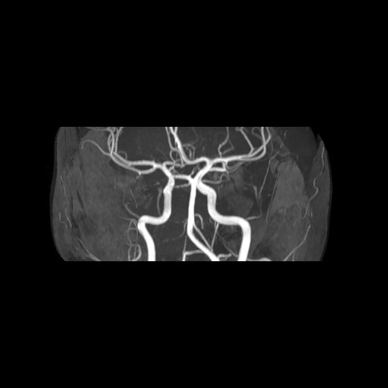 File:Artery of Percheron infarct (Radiopaedia 40966-43676 G 34).jpg