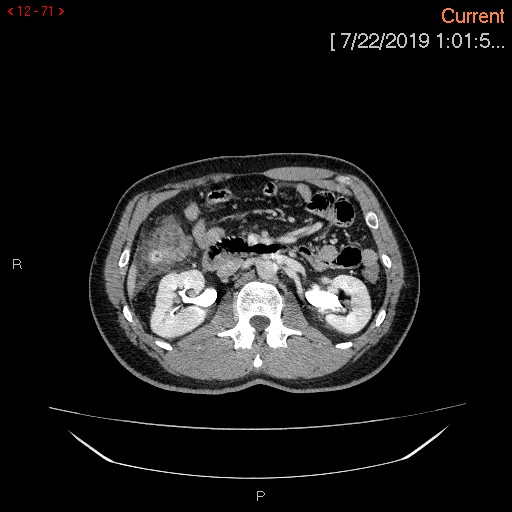 Ascending colonic diverticulum mimicking acute appendicitis (Radiopaedia 69943-80198 A 71).jpg