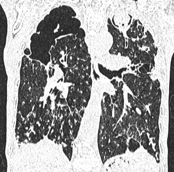 Aspergilloma- with Monod sign (Radiopaedia 44737-48532 Coronal lung window 279).jpg
