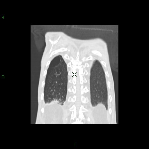 File:Aspergilloma (Radiopaedia 14842-14787 Coronal lung window 32).jpg