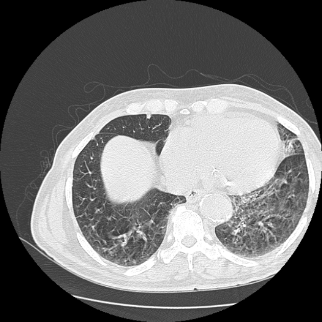 Aspergilloma (Radiopaedia 44592-48327 Axial lung window 69).jpg