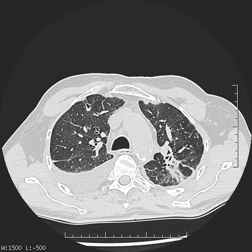 Aspergilloma (Radiopaedia 75184-86270 Axial lung window 15).jpg