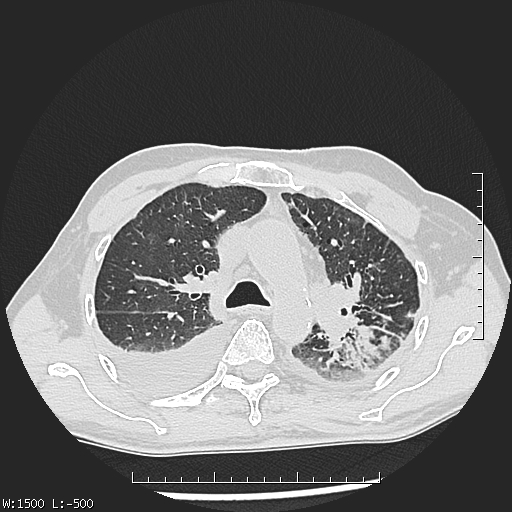 Aspergilloma (Radiopaedia 75184-86270 Axial lung window 17).jpg