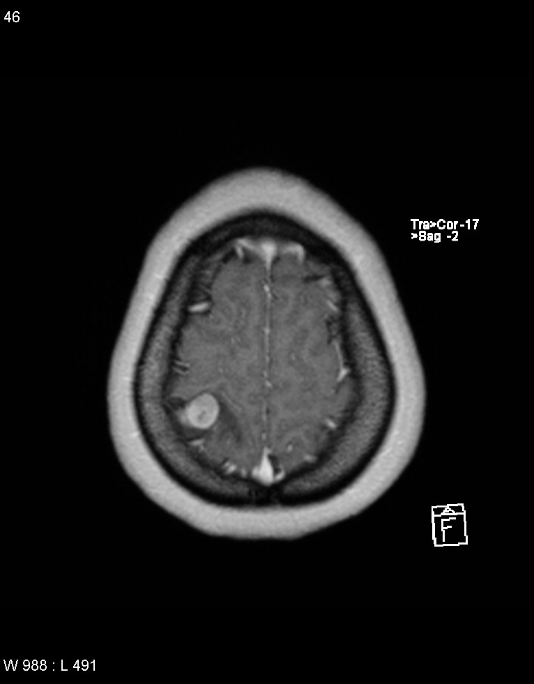 Astroblastoma (Radiopaedia 39792-42217 Axial T1 C+ 45).jpg