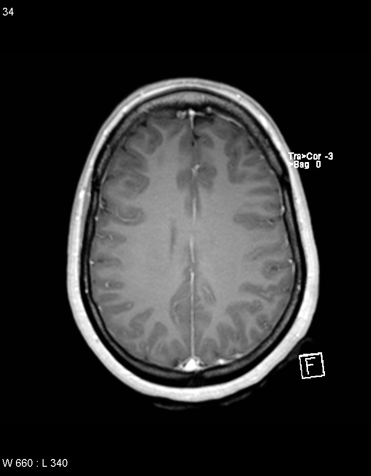 Astroblastoma (Radiopaedia 39792-42218 Axial T1 C+ 33).jpg