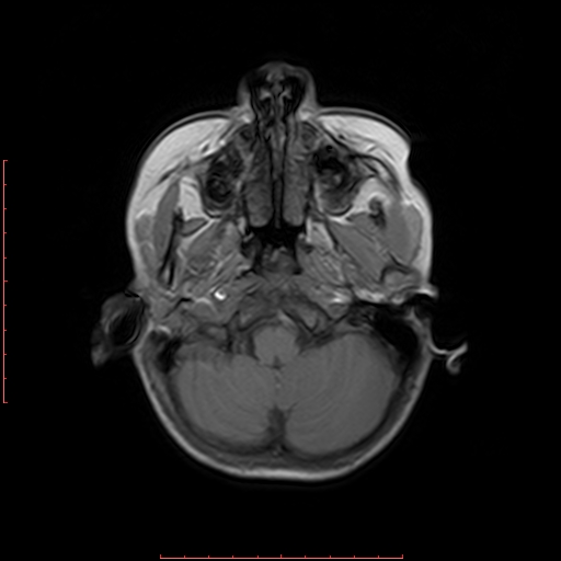 File:Astroblastoma (Radiopaedia 74287-85162 Axial T1 2).jpg