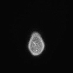 Astrocytoma (Radiopaedia 85660-101440 I 161).jpg