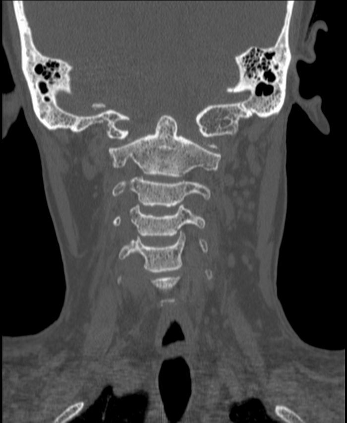 Atlanto-occipital assimilation with basilar invagination (Radiopaedia 70122-80188 Coronal bone window 93).jpg