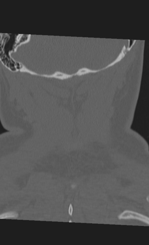 Atlanto-occipital dissociation (Radiopaedia 33848-35013 Coronal bone window 50).png