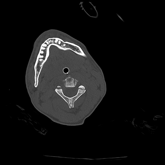 File:Atlanto-occipital dissociation (Traynelis type 1), C2 teardrop fracture, C6-7 facet joint dislocation (Radiopaedia 87655-104061 Axial bone window 35).jpg