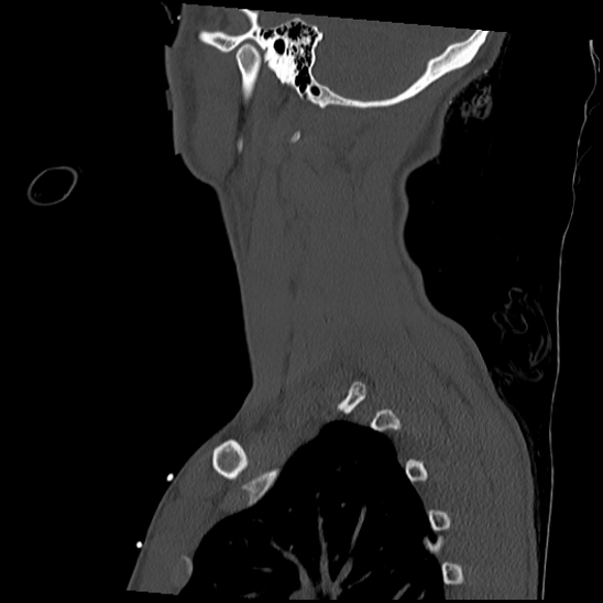 Atlanto-occipital dissociation (Traynelis type 1), C2 teardrop fracture, C6-7 facet joint dislocation (Radiopaedia 87655-104061 Sagittal bone window 57).jpg