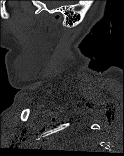 Atlanto-occipital dissociation - Traynelis type 1 (Radiopaedia 87570-103948 Sagittal bone window 16).jpg