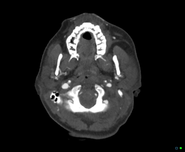 File:Atlanto-occipital dissociation - Traynelis type 1 (Radiopaedia 87570-103949 A 54).jpg
