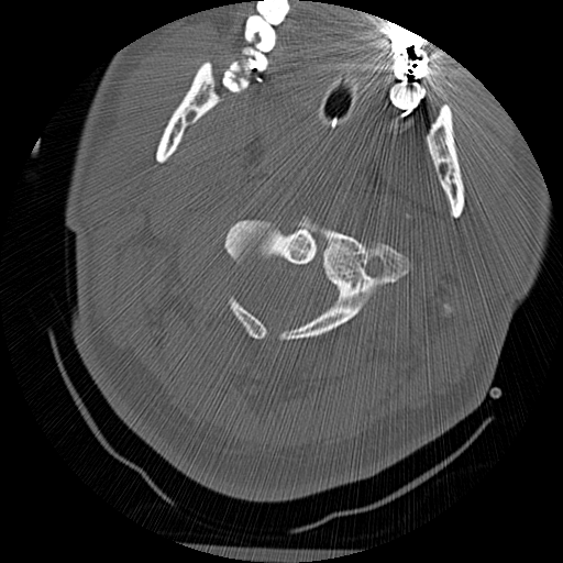 Atlanto-occipital dissociation injury (Radiopaedia 29274-29698 Axial bone window 17).png