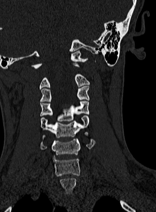 Atlantoaxial subluxation (Radiopaedia 44681-48450 Coronal bone window 69).jpg