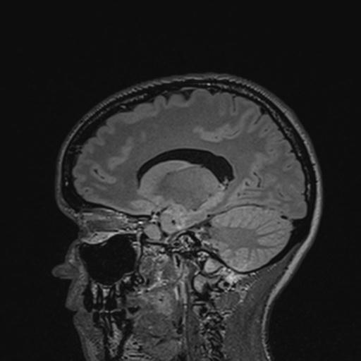 Atretic encephalocoele with inferior vermis hypoplasia (Radiopaedia 30443-31108 Sagittal FLAIR 67).jpg