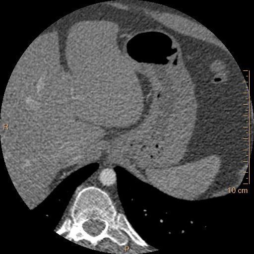 Atrial septal defect (upper sinus venosus type) with partial anomalous pulmonary venous return into superior vena cava (Radiopaedia 73228-83961 A 296).jpg