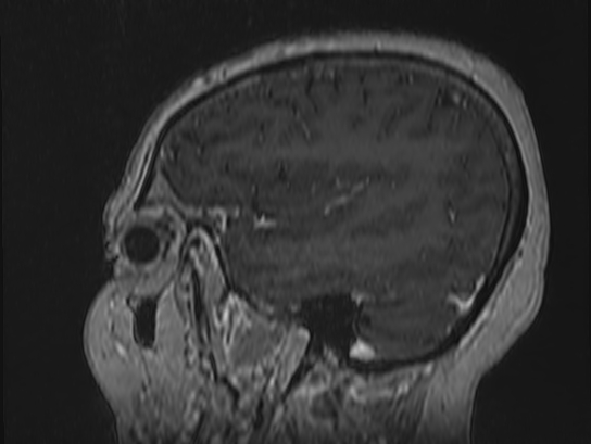 Atypical meningioma (Radiopaedia 62985-71406 Sagittal T1 C+ 15).jpg