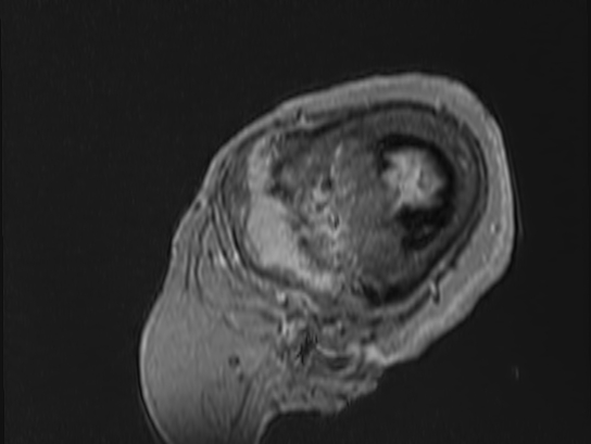Atypical meningioma (Radiopaedia 62985-71406 Sagittal T1 C+ 96).jpg