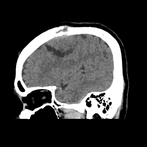 Atypical meningioma (WHO grade II) with osseous invasion (Radiopaedia 53654-59715 C 14).png