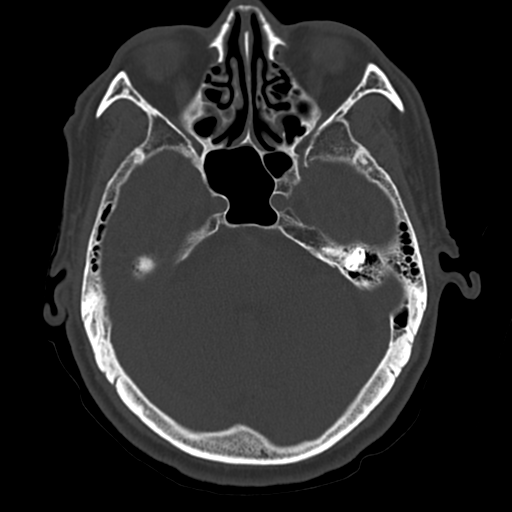 Atypical meningioma with skull invasion (Radiopaedia 34357-35649 Axial bone window 25).png