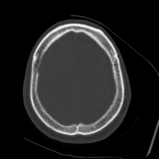 Atypical meningioma with skull invasion (Radiopaedia 34357-35649 Axial bone window 66).png