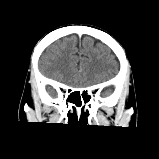 Atypical meningioma with skull invasion (Radiopaedia 34357-35649 Coronal C+ delayed 19).png