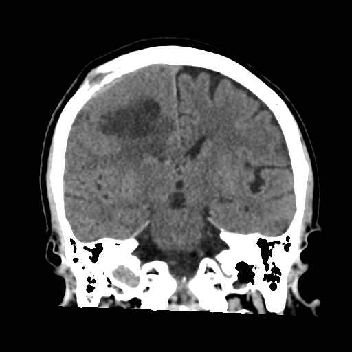 Atypical meningioma with skull invasion (Radiopaedia 34357-35649 Coronal non-contrast 35).png