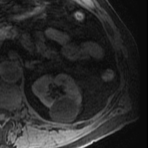 File:Atypical renal cyst on MRI (Radiopaedia 17349-17046 Axial T1 fat sat 11).jpg
