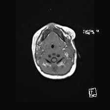 Atypical teratoid rhabdoid tumor (prenatal US and neonatal MRI) (Radiopaedia 59091-66388 Axial T1 4).jpg