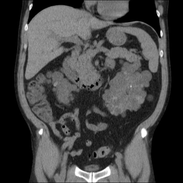 Autosomal dominant polycystic kidney disease (Radiopaedia 36539-38101 C 30).jpg