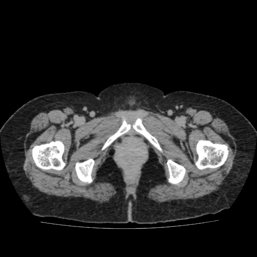 File:Autosomal dominant polycystic kidney disease (Radiopaedia 38189-40194 Axial C+ delayed 63).jpg