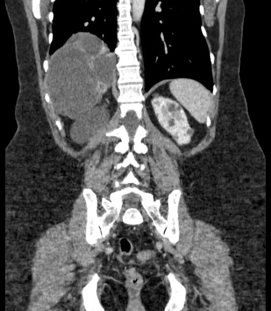 Autosomal dominant polycystic kidney disease (Radiopaedia 57124-64017 B 58).jpg