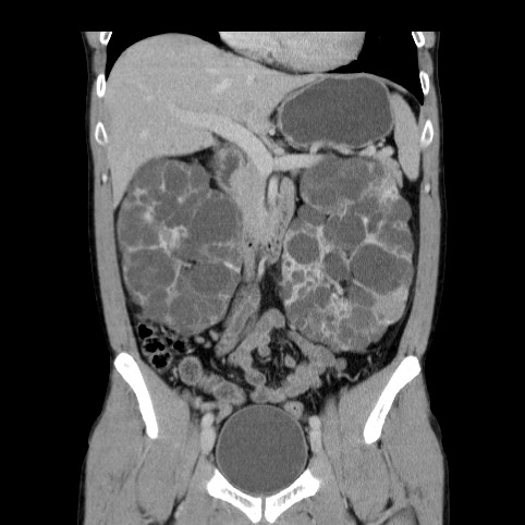 Autosomal dominant polycystic kidney disease (Radiopaedia 66349-75582 A 32).jpg