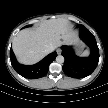 Autosomal dominant polycystic kidney disease (Radiopaedia 66349-75582 B 9).jpg