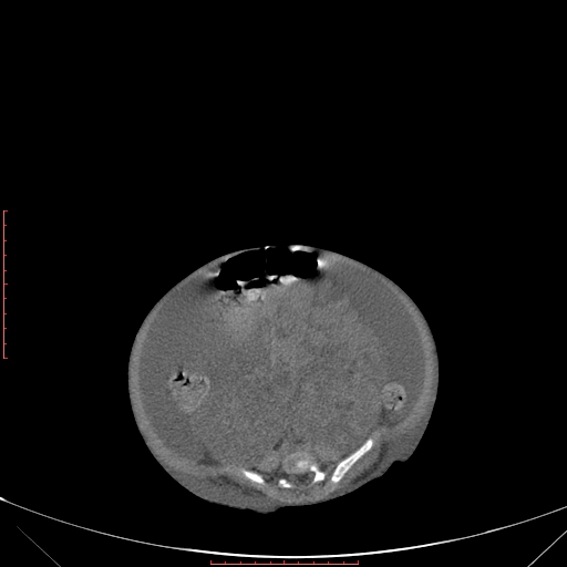 Autosomal recessive polycystic kidney disease associated with Caroli disease (Radiopaedia 61932-69984 Axial non-contrast 267).jpg