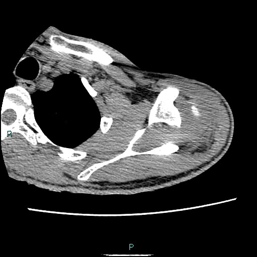File:Avascular necrosis after fracture dislocations of the proximal humerus (Radiopaedia 88078-104653 D 26).jpg