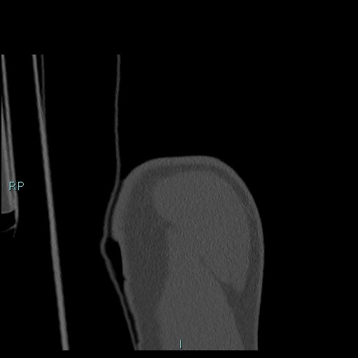 Avascular necrosis after fracture dislocations of the proximal humerus (Radiopaedia 88078-104655 Coronal bone window 21).jpg