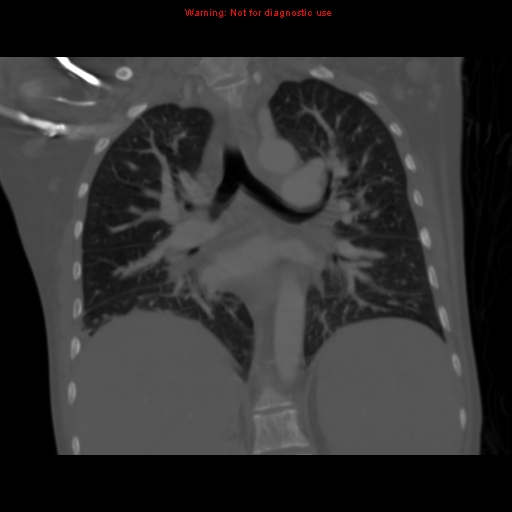 File:Avascular necrosis in sickle cell disease (Radiopaedia 17448-17152 Coronal bone window 74).jpg