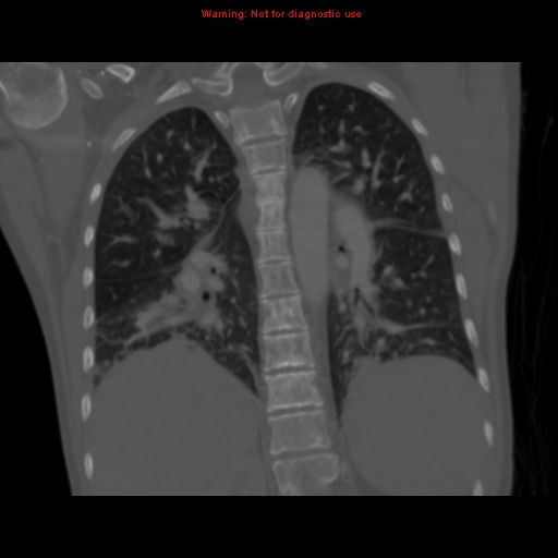 Avascular necrosis in sickle cell disease (Radiopaedia 17448-17152 Coronal bone window 85).jpg