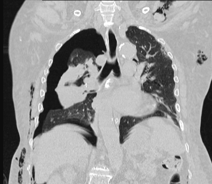 Barotrauma due to mechanical ventilation (Radiopaedia 28079-28336 Coronal lung window 56).jpg