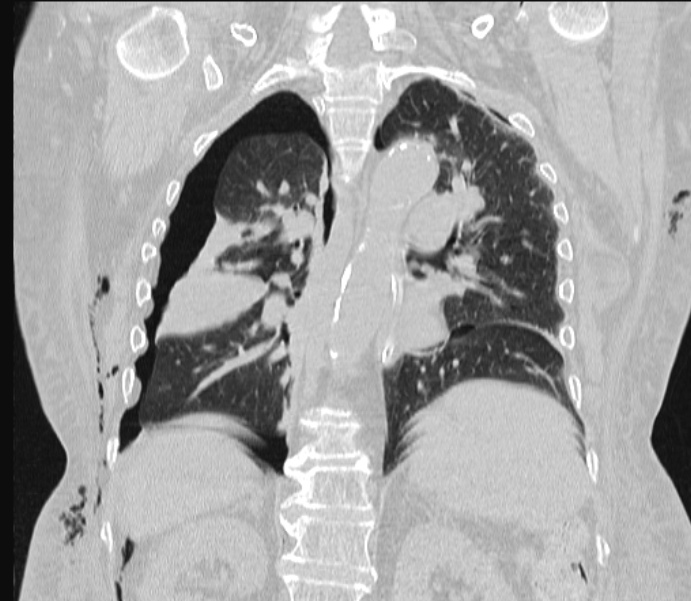 Barotrauma due to mechanical ventilation (Radiopaedia 28079-28336 Coronal lung window 62).jpg