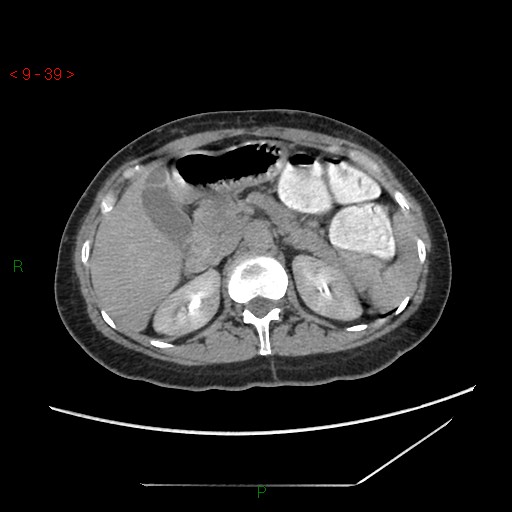 File:Bartholin gland cyst (Radiopaedia 54904-61181 Axial C+ delayed 10).jpg