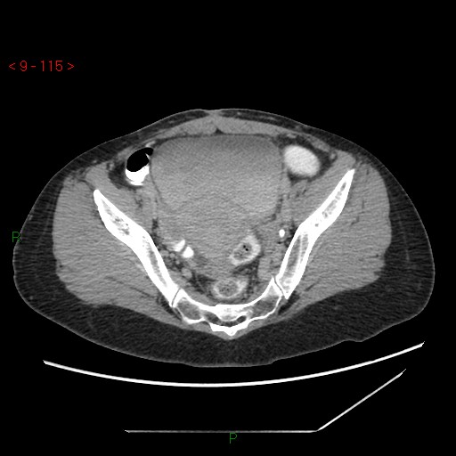 File:Bartholin gland cyst (Radiopaedia 54904-61181 Axial C+ delayed 29).jpg
