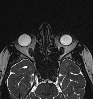 Basal cell carcinoma - nasal region (Radiopaedia 70292-80365 Axial Gradient Echo 64).jpg