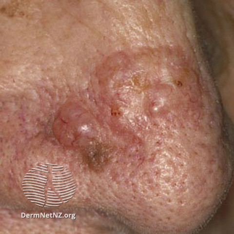 File:Basal cell carcinoma affecting the nose (DermNet NZ lesions-bcc-nose-0629).jpg